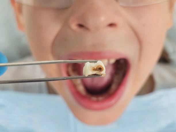 Best Emergency Tooth Extraction in Hermitage, PA